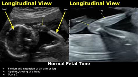 bps ultrasound